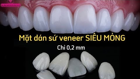 Ưu điểm của phương pháp dán sứ veneer siêu mỏng | Tt niềng răng quốc tế Diamond