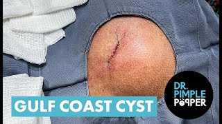 Dr Pimple Popper Opens The 'Gulf Coast' Cyst screenshot 5
