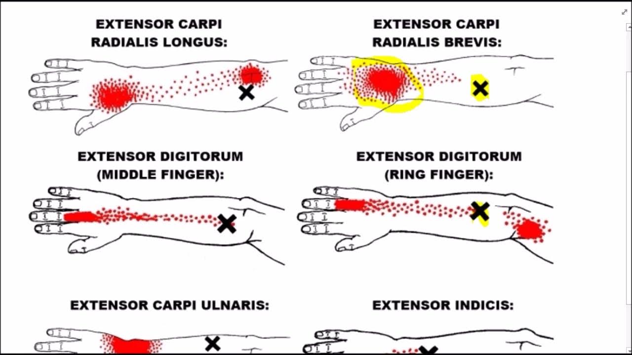 5 minute fix for LoL & gaming wrist pain YouTube