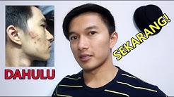 Salah Satu Rahasia PEJUANG JERAWAT!!! Gue - Durasi: 6.54. 