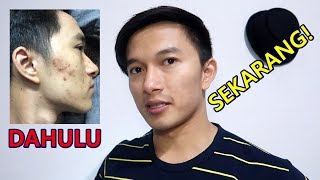 VIRAL !!!!!!! MENGHILANGKAN JERAWAT MENGGUNAKAN ES BATU AIR BERAS!!!!!!!!!! 😱