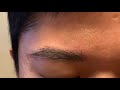 Dallas Asian Eyebrow Hair Transplant