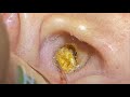 ASMR耳掃除: 超大型の耳垢除去器、内部に密封されています👂💦