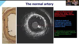 Optimizing PCI Using FFR and HD IVUS: Part 2 - The Benefits of IVUS in Acute Coronary Syndrome