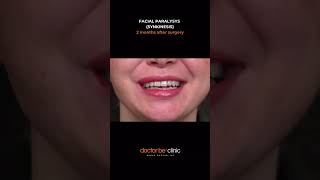 Sinkinezi, Fasiyal Paralizi Sonrası En Sık Görülen Komplikasyonlardan Biridir