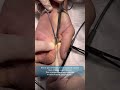 Рассечение кольцевидной связки А1-2