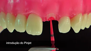Quando indicar pino intra-radicular?
