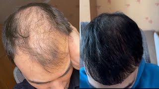 Результат пересадки волос спустя 8 месяцев, 5100 графтов