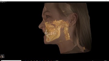 Create beautiful case presentations with the CS 9600 5-in-1 CBCT and CS 3700 Intraoral Scanner