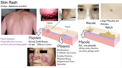 Understanding Rash in  3 minutes. Skin Rash types ...