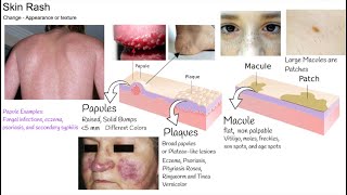 Understanding Rash in  3 minutes. Skin Rash types and causes.