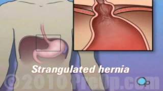 PreOp® Patient Education Hernia - Hiatal Open Repair