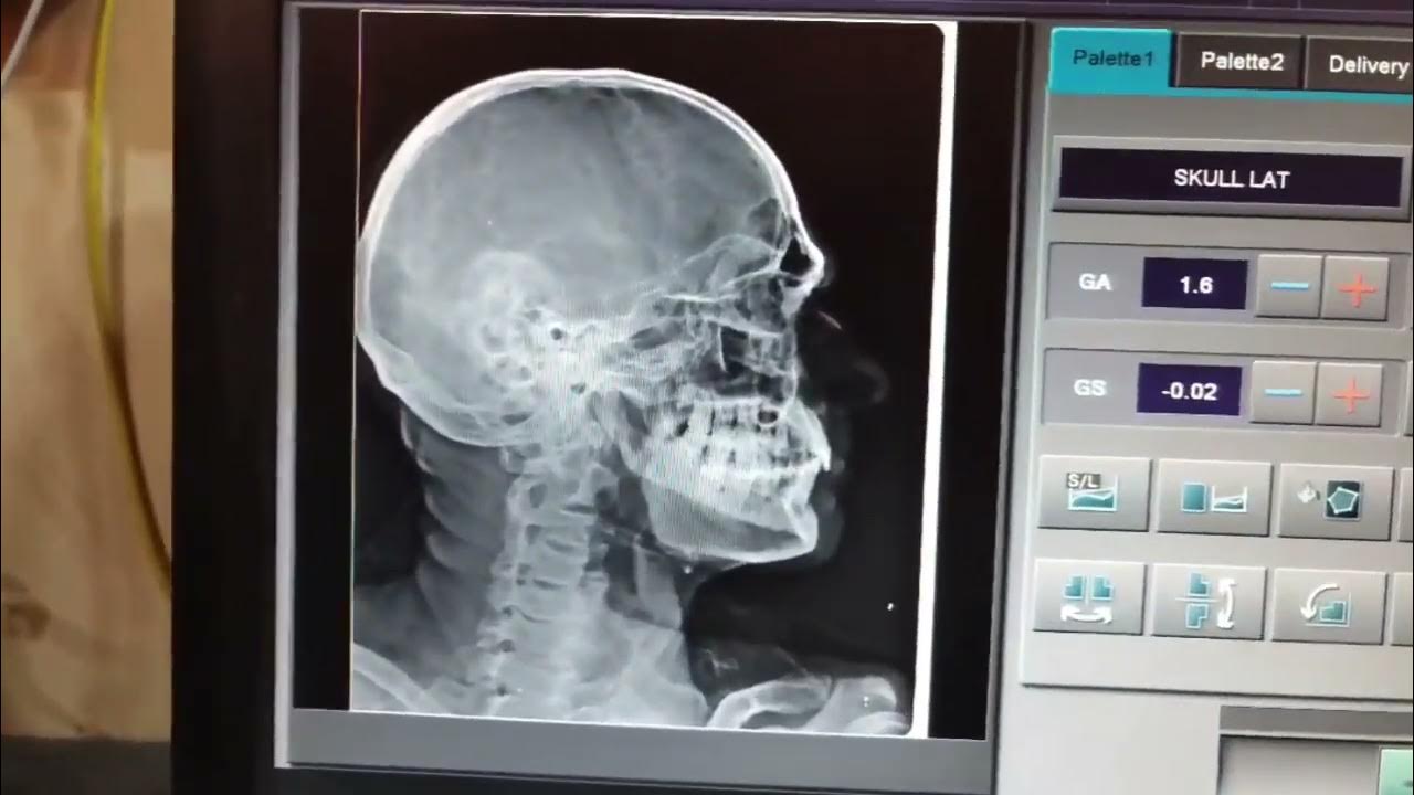 HOW TO X RAY ORBIT AP/LAT YouTube