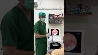 #surgery #mouthbreathing #sleepapnea #tonsilstones