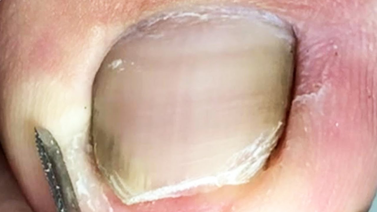 Toenails damaged by patients, trimmed again【Crazy pedicure room】 YouTube