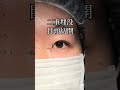 【二重整形】二重埋没取れちゃう人？取れない人？#shorts