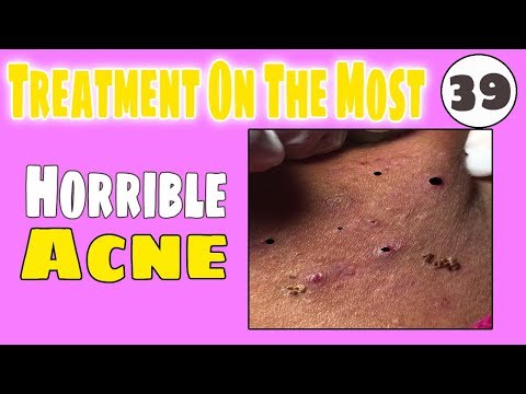 Cystic Acne Treatment Jully  - How to get rid of horrible acne on face