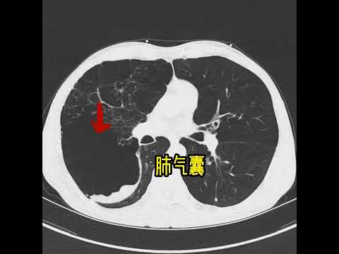 Video: Apa itu pneumatokel paru?