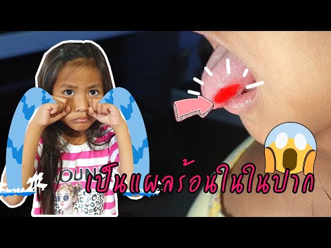 เจ็บมาก...เป็นแผลร้อนในที่ลิ้น I หนูดีเป็นร้อนใน I หนูดีมาแล้วจ้า