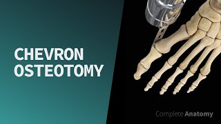 Chevron Osteotomy