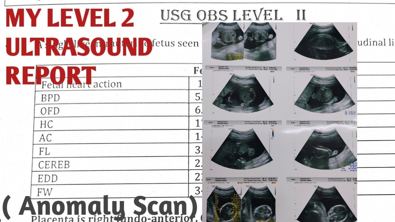 My Anomaly Scan Report Level 2 Ultrasound YouTube My Anomaly Scan Report Level 2 Ultrasound YouTube