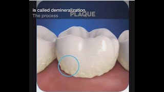 Stage 1 Of Tooth Decay Demineralization