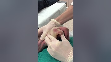 Closed Reduction of 5th Metacarpal Fracture