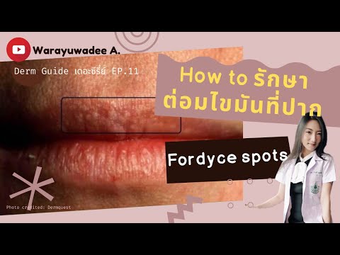 How to รักษาต่อมไขมันจุดขาวที่ปาก Fordyce spots | Derm Guide เดอะซีรี่ย์หมอผิวหนัง EP.11