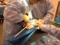 Unicompartmental knee arthroplasty   dr mahmoud hafez