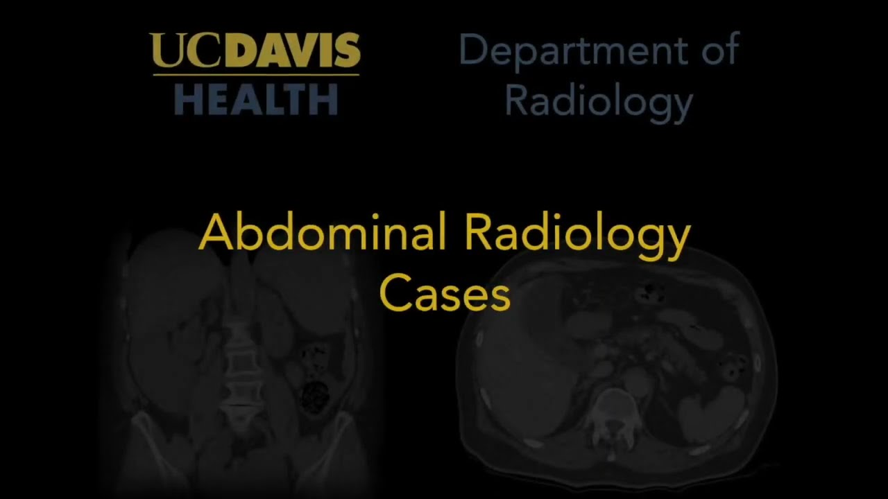 Chorionic bump on obstetrical ultrasound