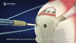 Double Medical All-Suture Anchor system - connection and fixation of soft tissues and bones solution screenshot 4