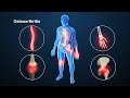 Osteoarthritis | Nucleus Health