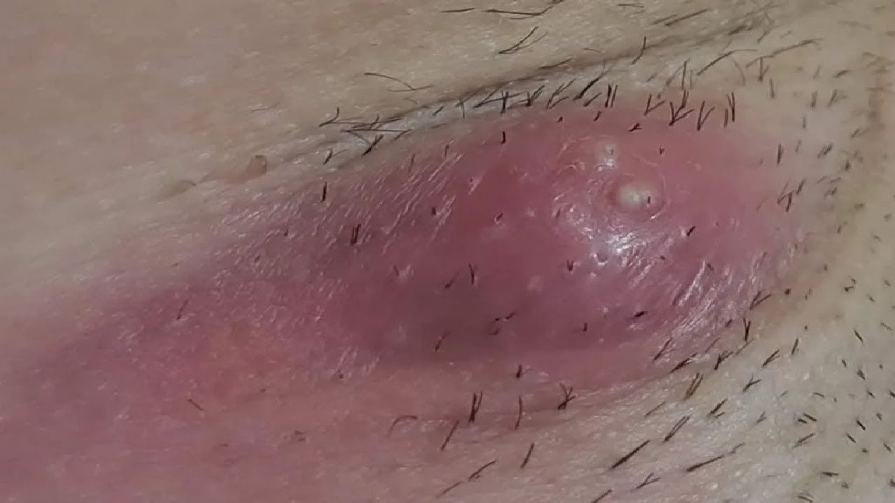 how-to-get-rid-of-a-boil-under-your-armpit-in-1-day-youtube