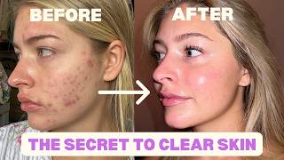 HOW I CLEARED MY ACNE // progress pics, accutane, + essential products