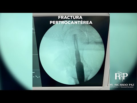 Fractura Pertrocantérea en Cadera #casoclínico #cadera
