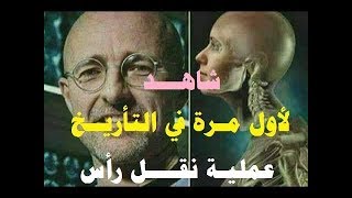 عملية نقل الرأس هذه النتأئج