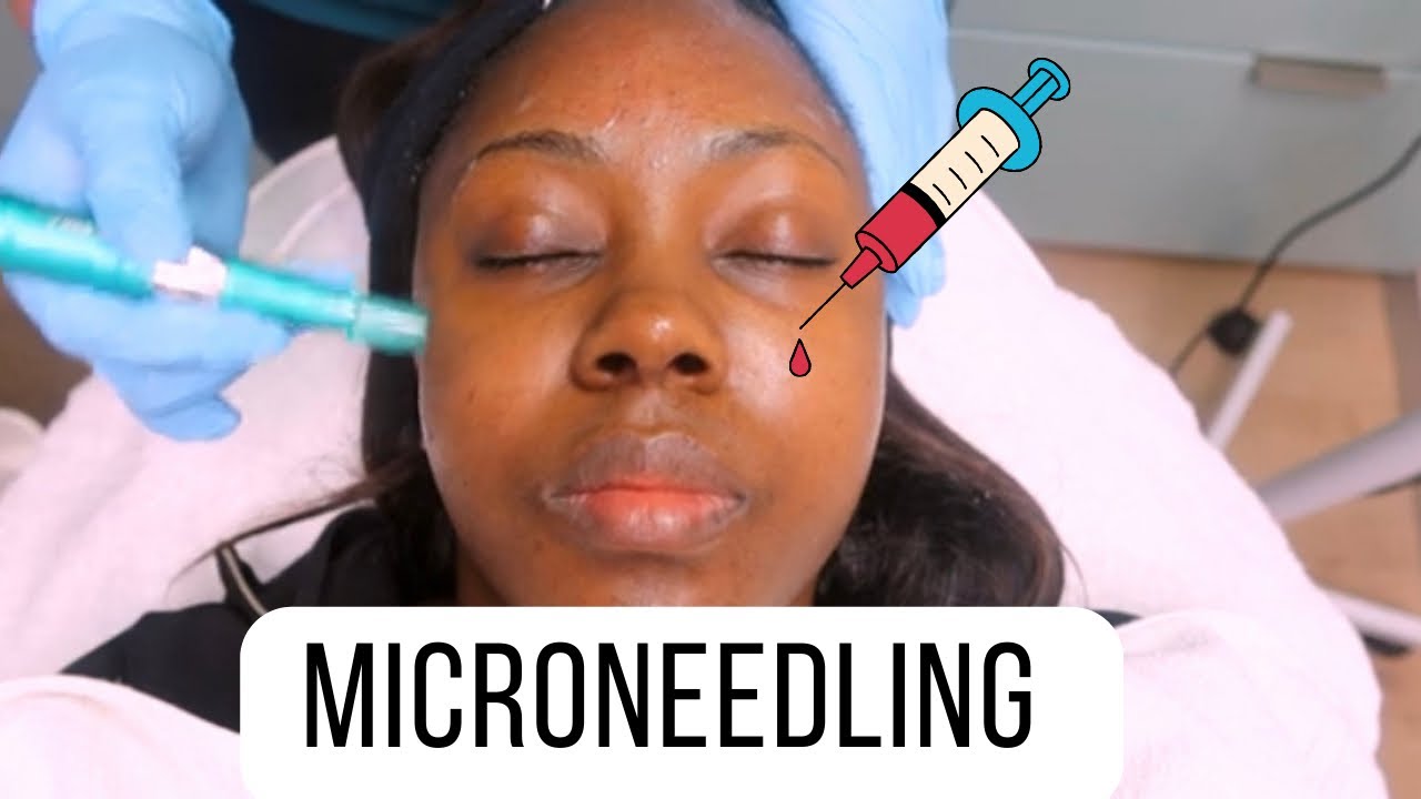 Microneedling Experience Microneedling for HYPERPIGMENTATION South