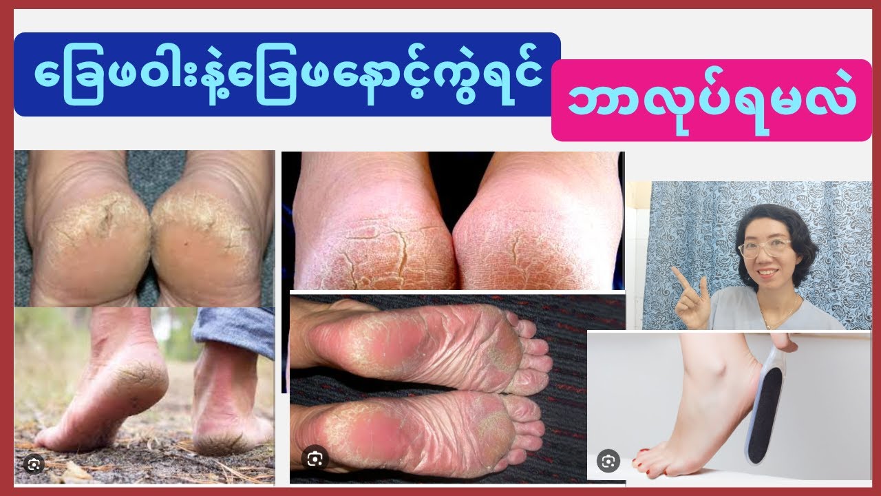 ခြေဖနောက်ကွဲခြင်းအကြောင်းနှင့်ထိန်းသိမ်းကုသခြင်းCracked heel treatment