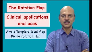 #The Rotation flap