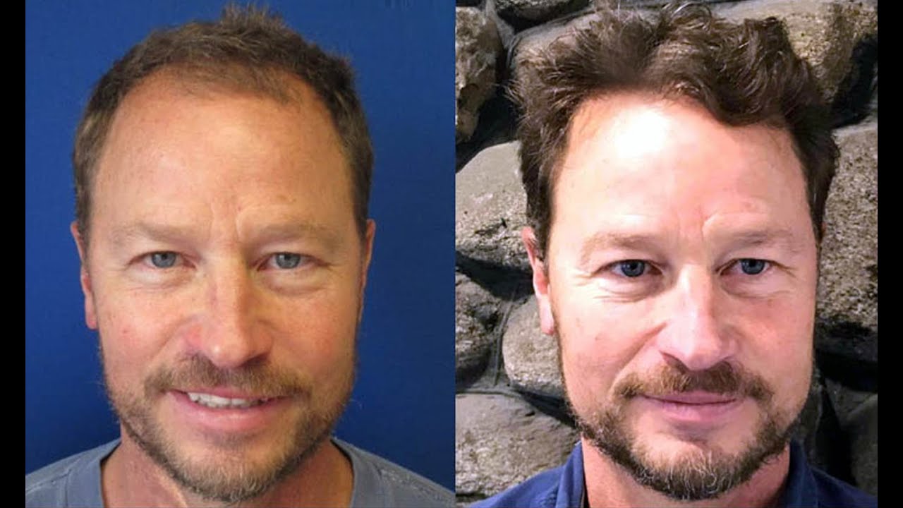 DiStefano Hair Restoration & Transplants | MA, CT, RI and NH