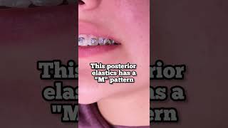 Rubber Bands and Braces - This posterior elastics in a M pattern - Toothtime Dentist New Braunfels