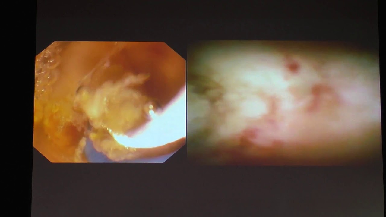 07Live Будзинский СА Опухоль Клацкина Холедохоскопия SpyGlass ...