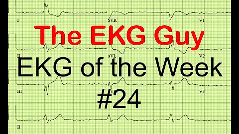 EKG/ECG of the Week #24 | The EKG Guy - www.ekg.md