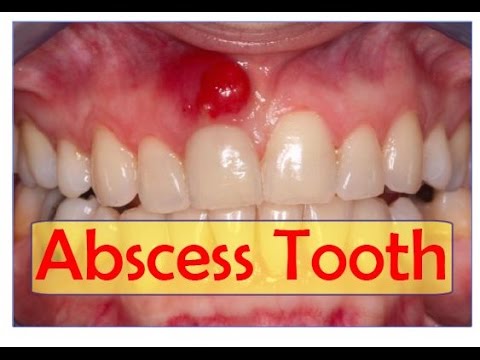 How is an abscessed tooth treated?