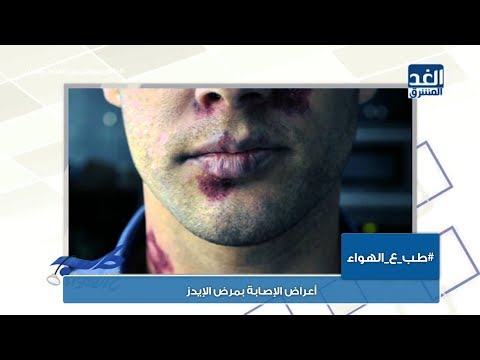 طب ع الهواء أعراض الإصابة بمرض الإيدز