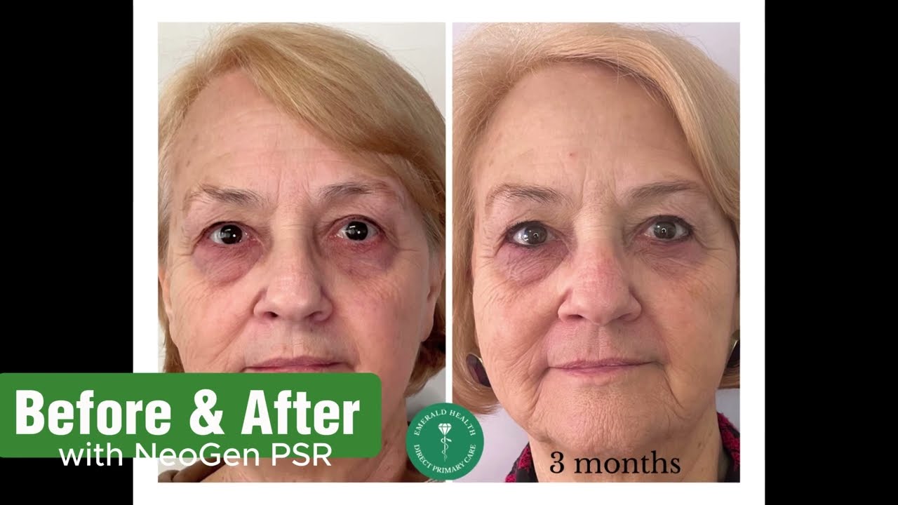 Radiant Rejuvenation: NeoGen PSR Plasma Skin Regeneration Experience | Hickory, NC