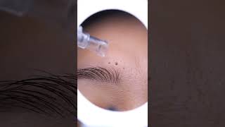 Comedone Extraction 🌟 #ASMR #skincare #beauty