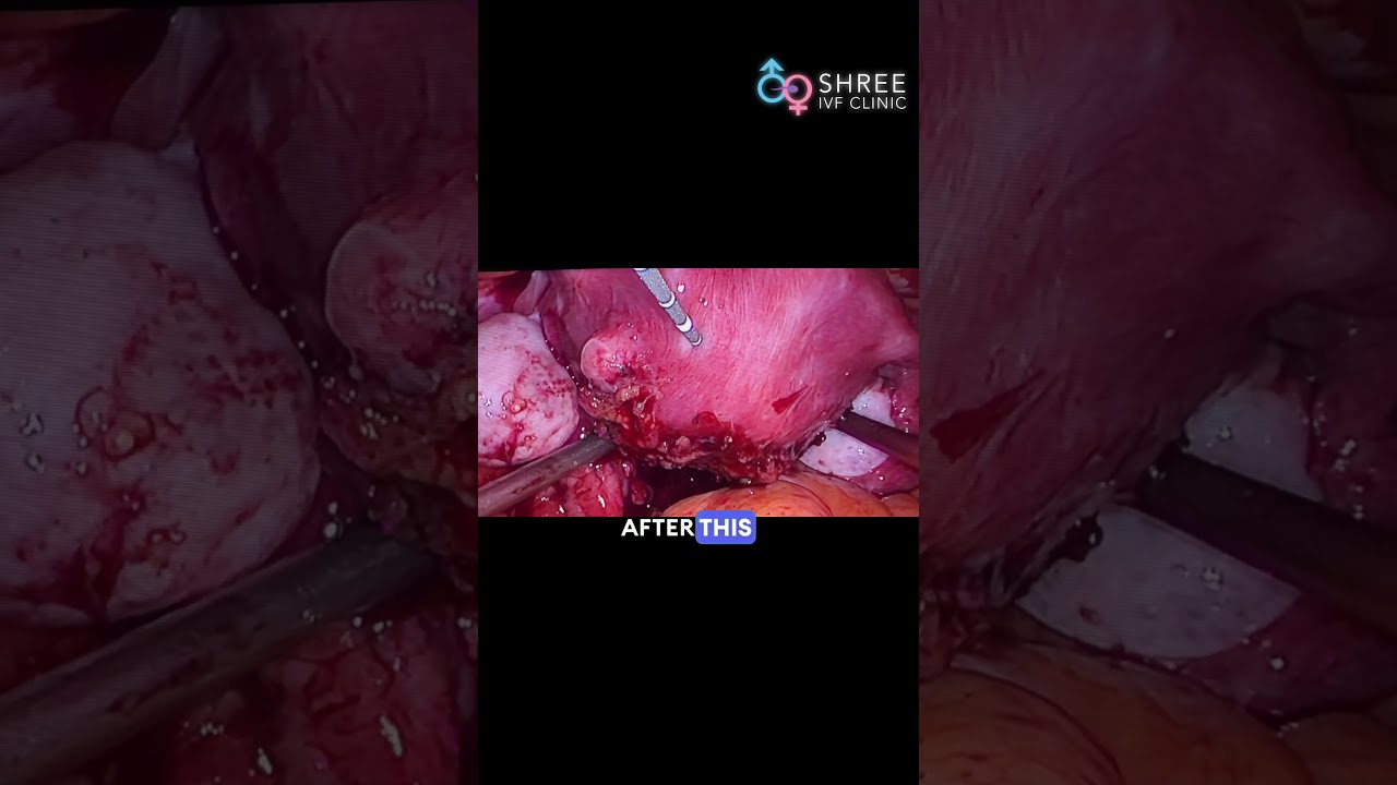 Adenomyosis Treatment That Works Microwave Ablation Explained Dr Jay Mehta Mumbai
