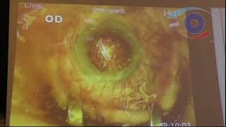 видео: Незрелая осложненная катаракта картинка: Незрелая осложненная катаракта