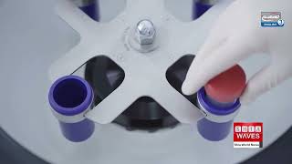 Researchers Develop Revolutionary Blood Test for Chronic Fatigue Syndrome